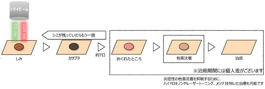 炭酸ガスレーザー