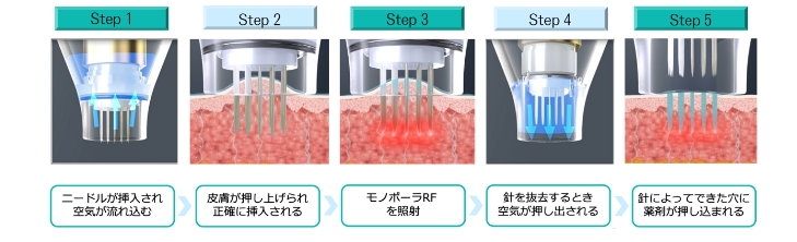 炭酸ガスレーザー